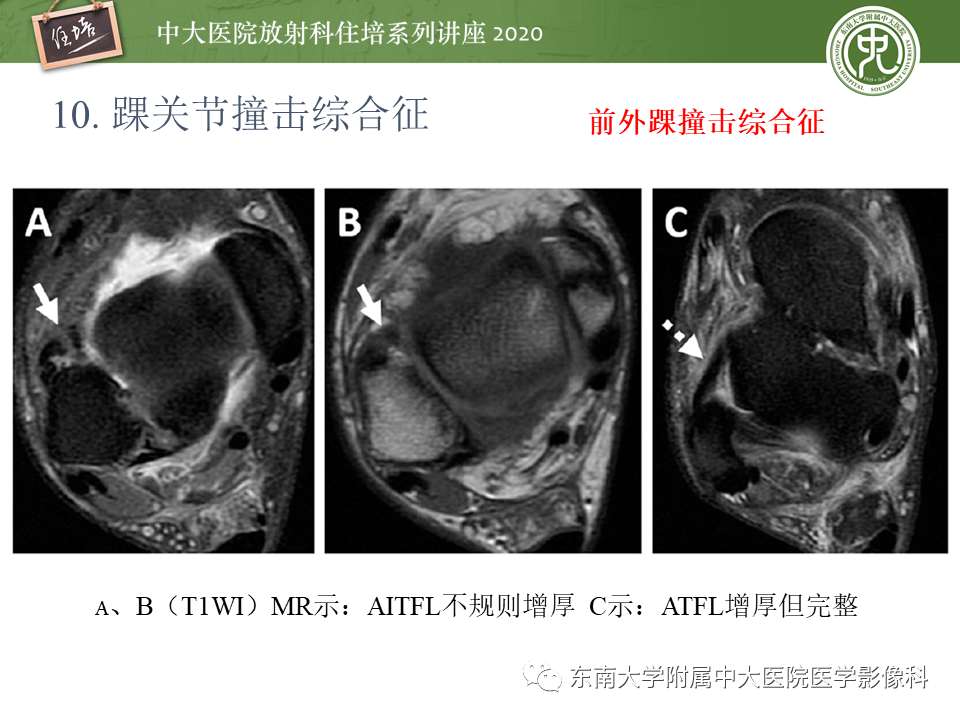 【PPT】常见撞击综合征的影像诊断-53