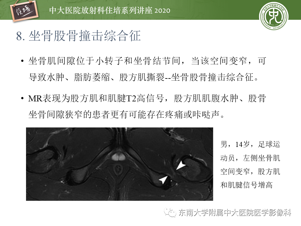 【PPT】常见撞击综合征的影像诊断-46