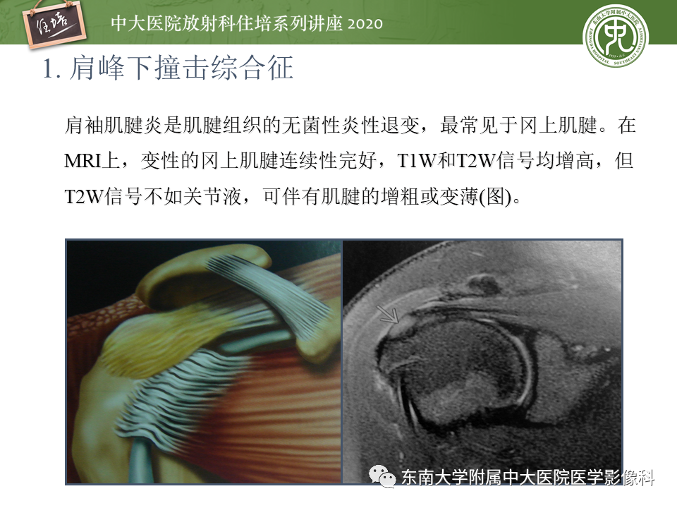 【PPT】常见撞击综合征的影像诊断-9