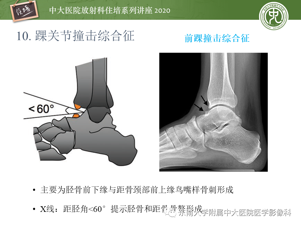 【PPT】常见撞击综合征的影像诊断-56