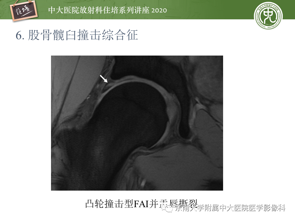 【PPT】常见撞击综合征的影像诊断-36