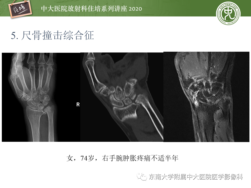 【PPT】常见撞击综合征的影像诊断-24