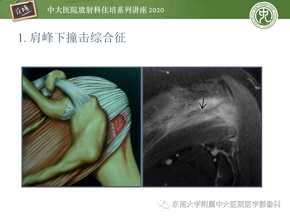 【PPT】常见撞击综合征的影像诊断-14