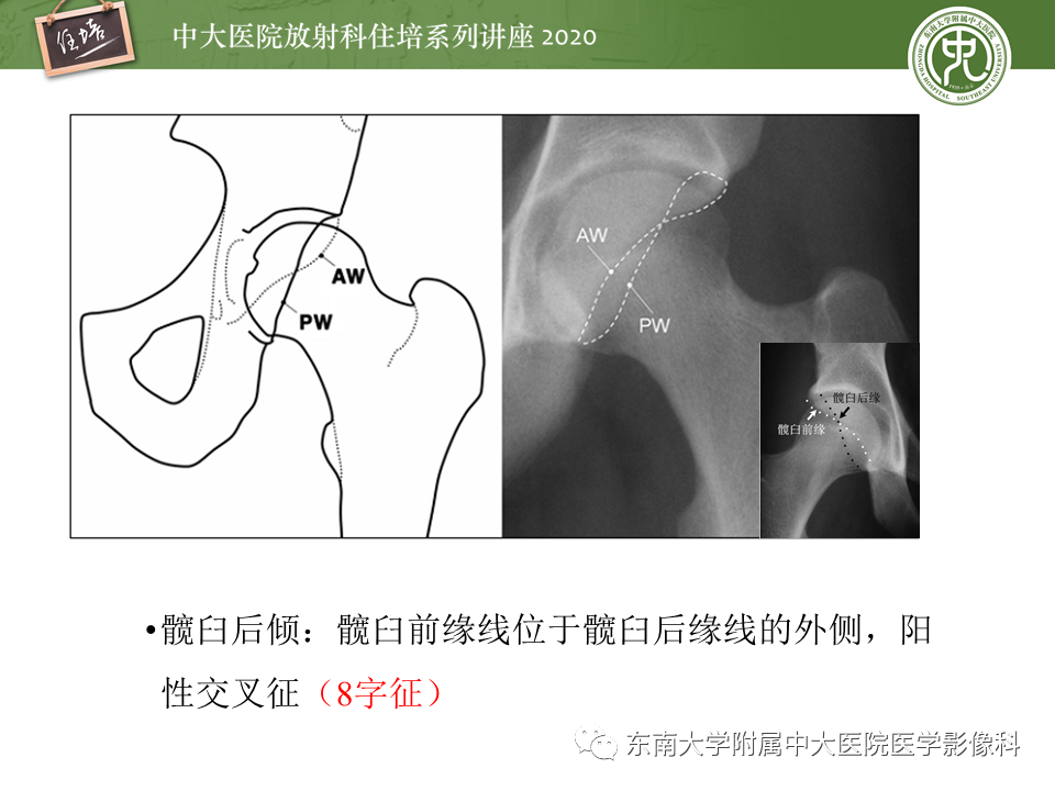 【PPT】常见撞击综合征的影像诊断-39