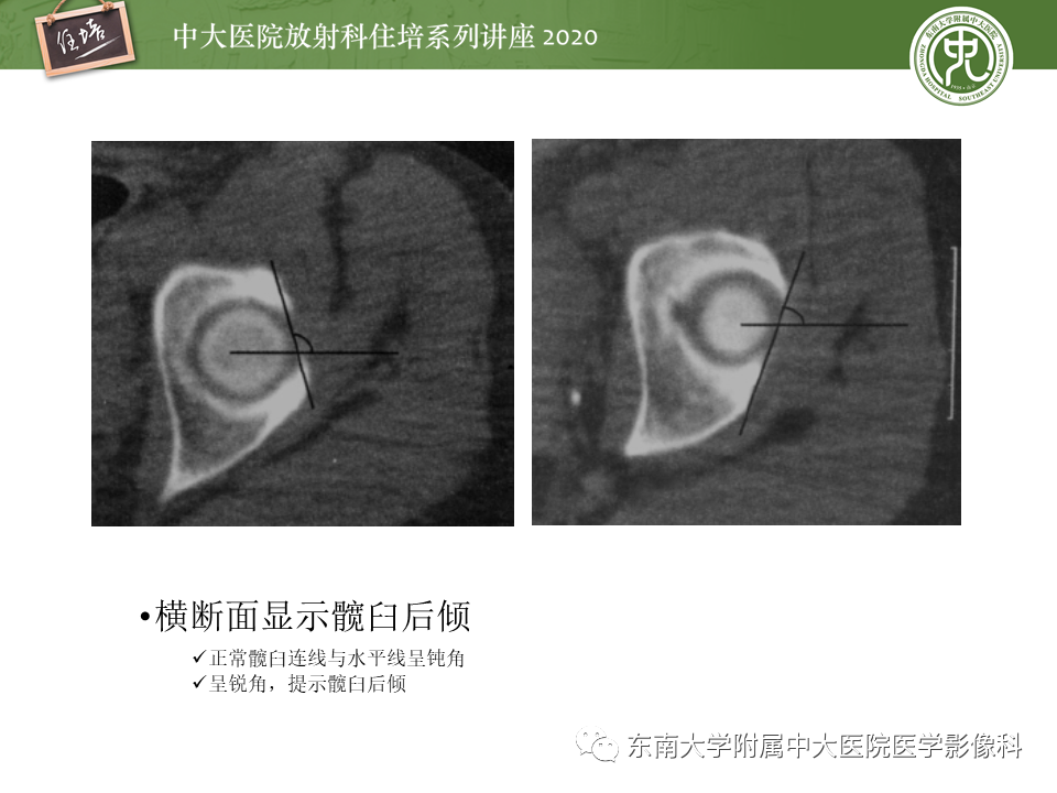 【PPT】常见撞击综合征的影像诊断-40