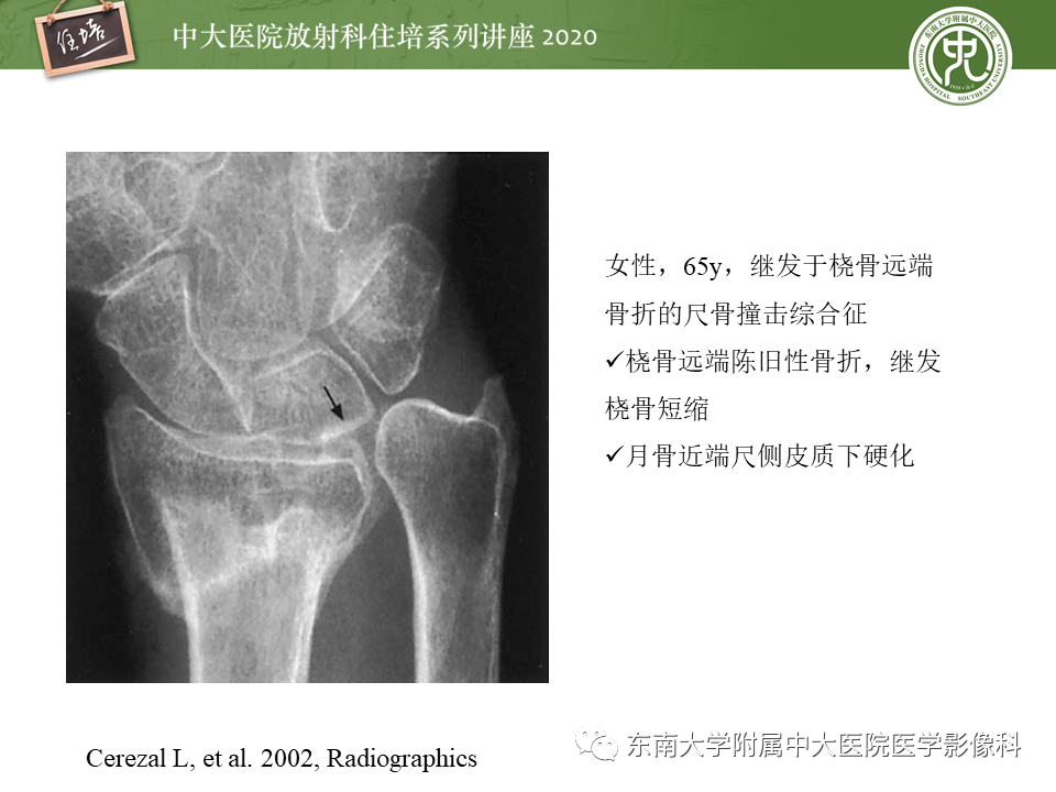 【PPT】常见撞击综合征的影像诊断-23