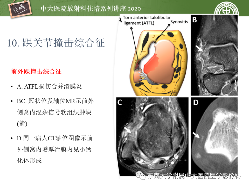 【PPT】常见撞击综合征的影像诊断-52