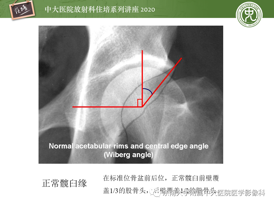 【PPT】常见撞击综合征的影像诊断-38