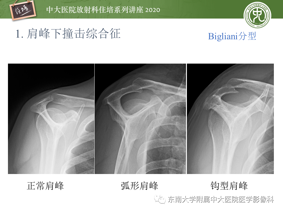 【PPT】常见撞击综合征的影像诊断-6