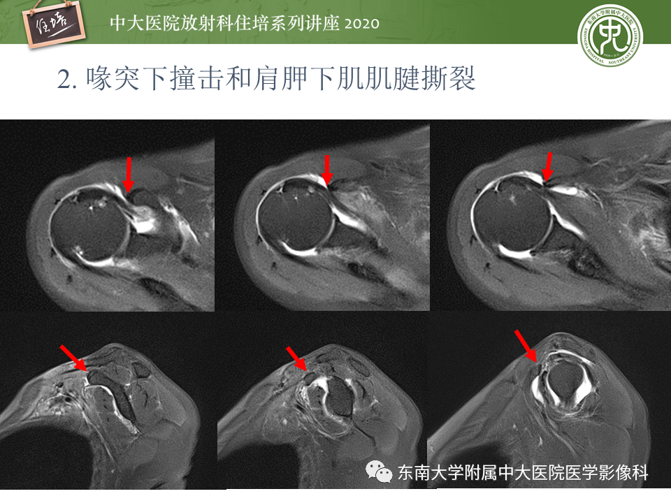 【PPT】常见撞击综合征的影像诊断-19
