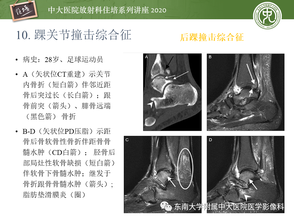 【PPT】常见撞击综合征的影像诊断-66