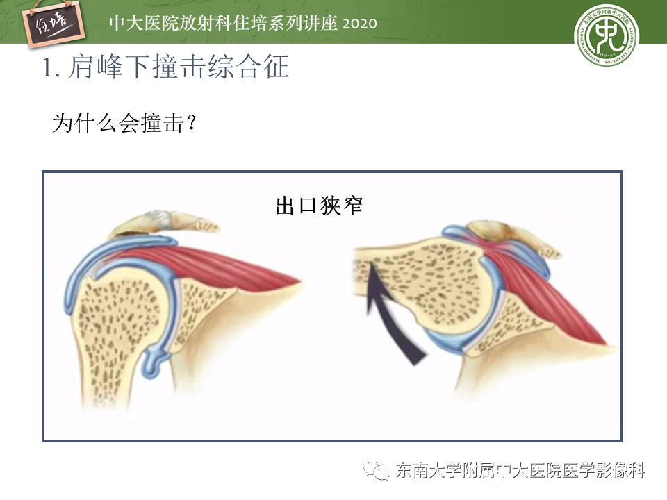【PPT】常见撞击综合征的影像诊断-4