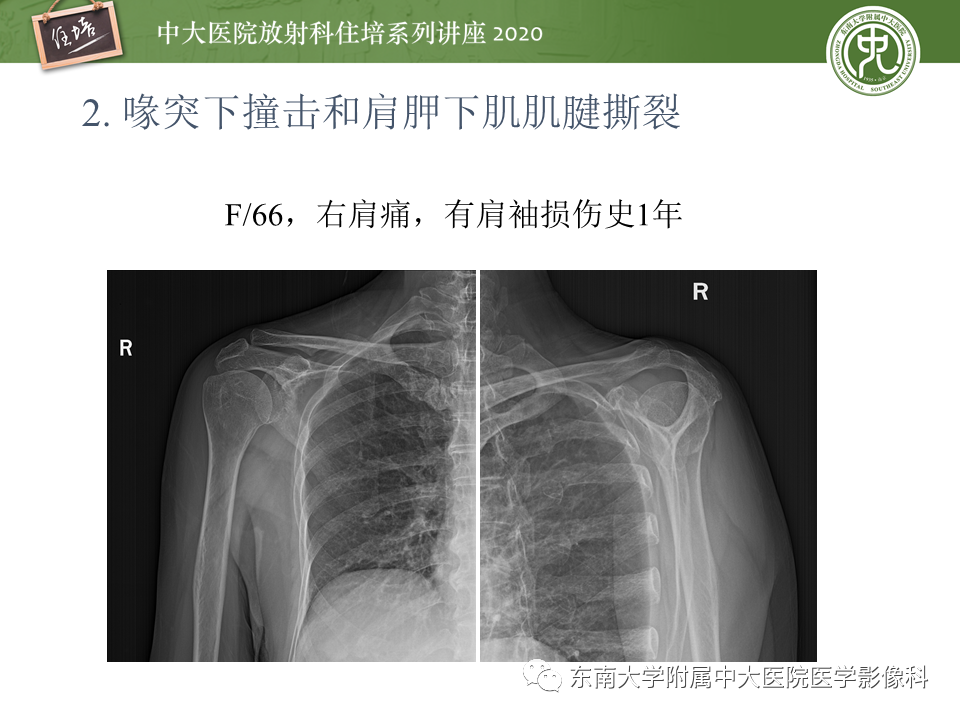 【PPT】常见撞击综合征的影像诊断-18