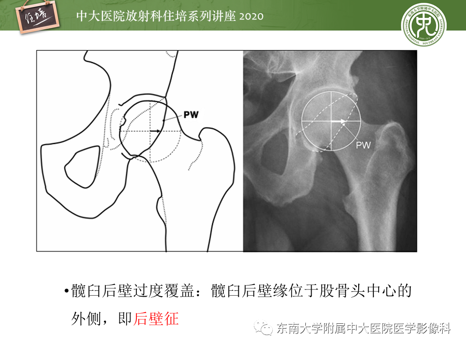 【PPT】常见撞击综合征的影像诊断-41