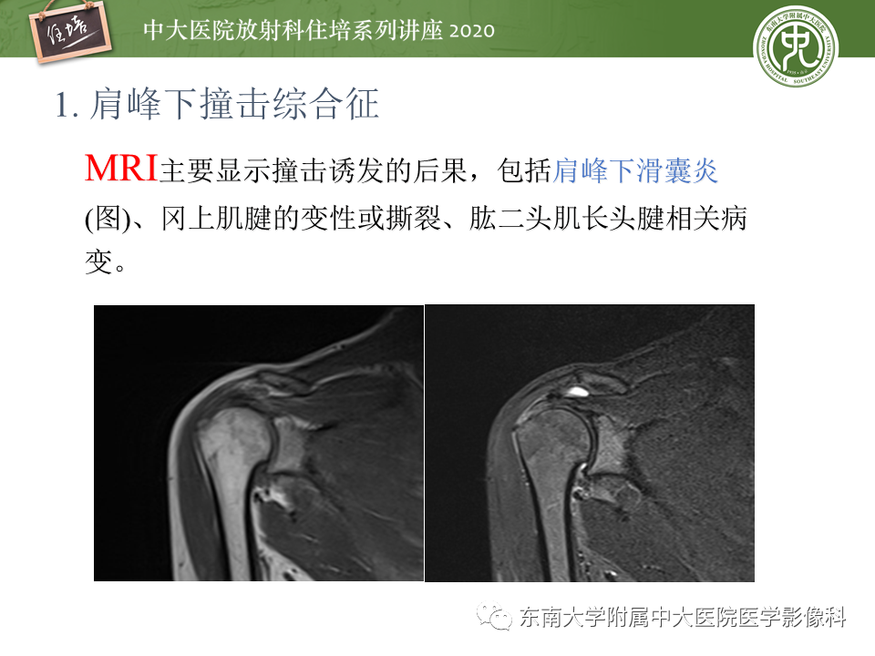 【PPT】常见撞击综合征的影像诊断-8