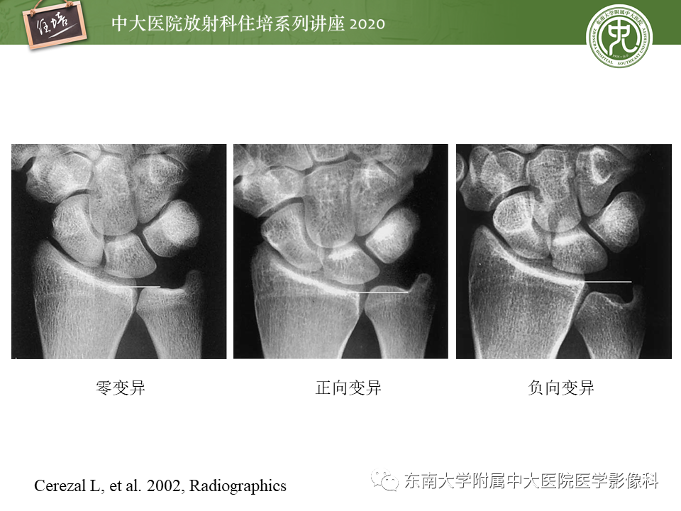 【PPT】常见撞击综合征的影像诊断-22