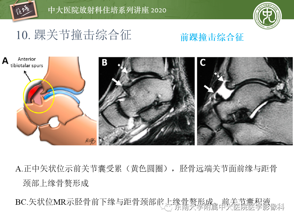 【PPT】常见撞击综合征的影像诊断-57