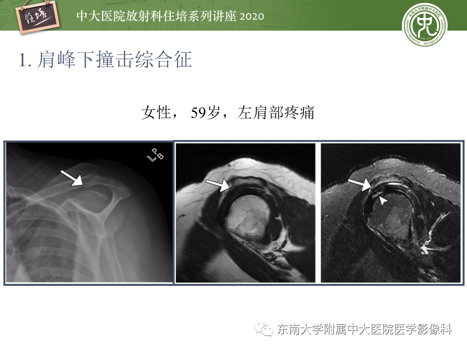 【PPT】常见撞击综合征的影像诊断-11