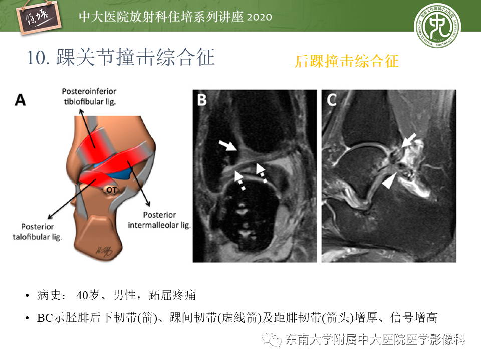 【PPT】常见撞击综合征的影像诊断-64
