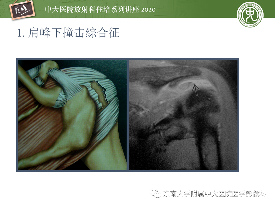 【PPT】常见撞击综合征的影像诊断-13