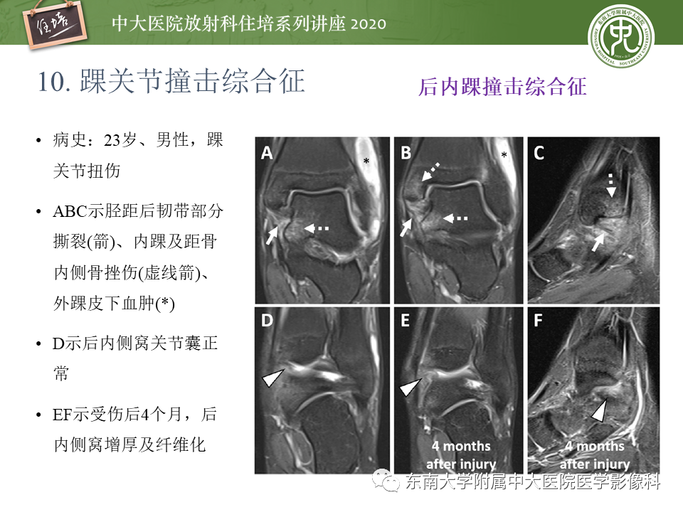 【PPT】常见撞击综合征的影像诊断-59