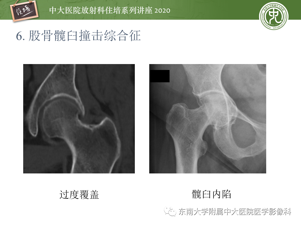 【PPT】常见撞击综合征的影像诊断-42