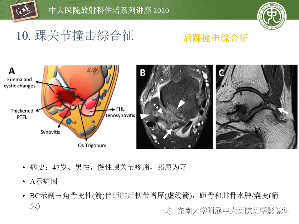 【PPT】常见撞击综合征的影像诊断-63