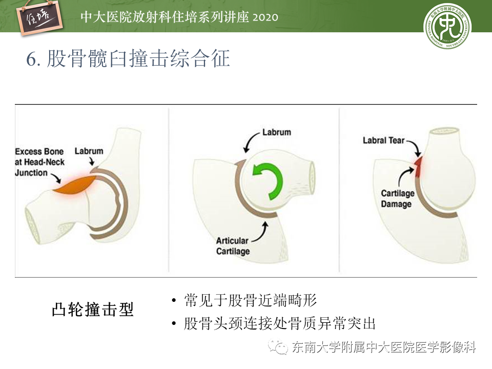 【PPT】常见撞击综合征的影像诊断-31