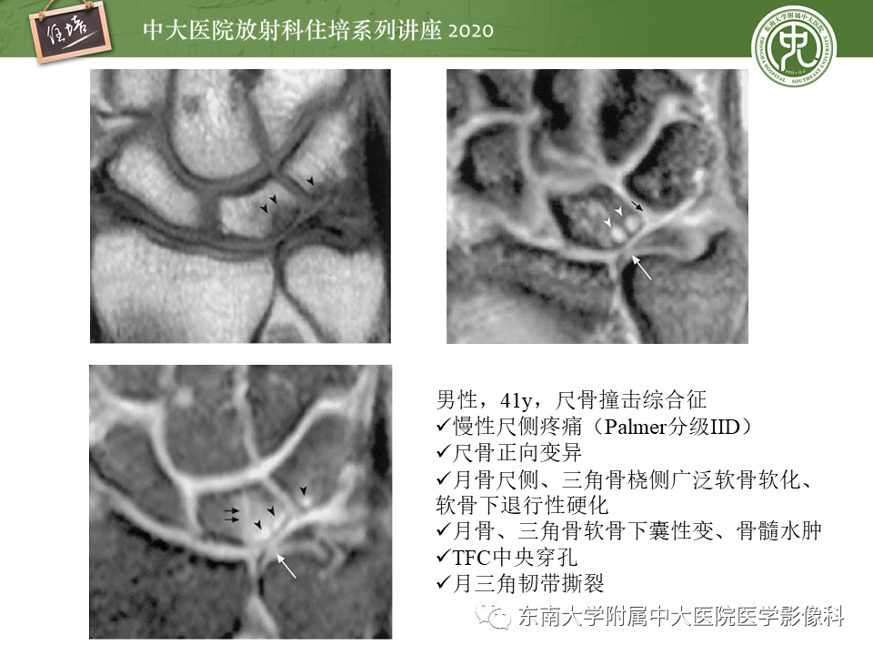 【PPT】常见撞击综合征的影像诊断-27