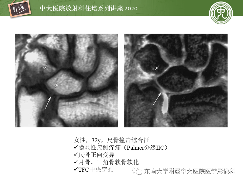 【PPT】常见撞击综合征的影像诊断-26
