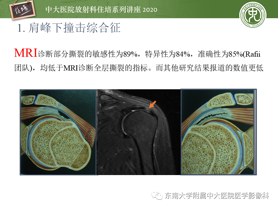 【PPT】常见撞击综合征的影像诊断-15