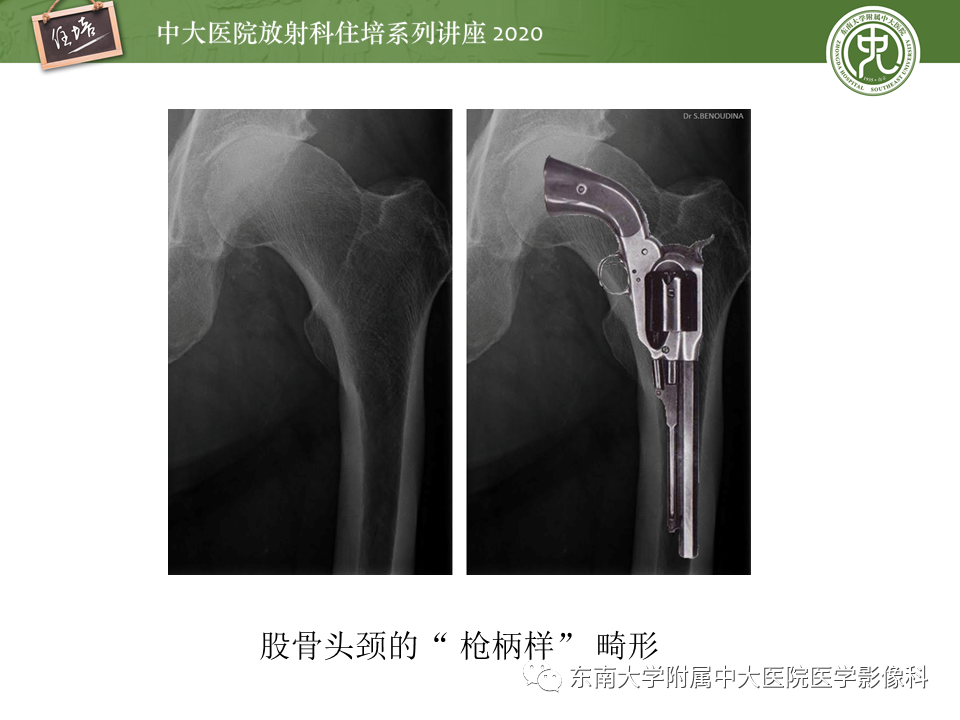 【PPT】常见撞击综合征的影像诊断-32
