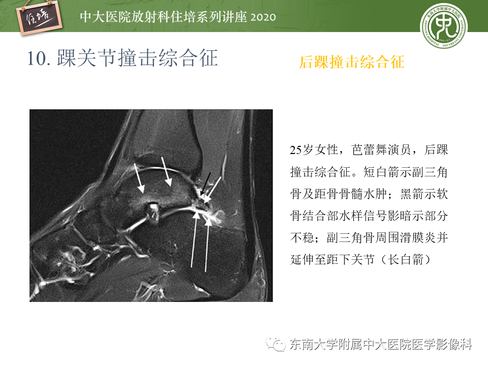 【PPT】常见撞击综合征的影像诊断-65