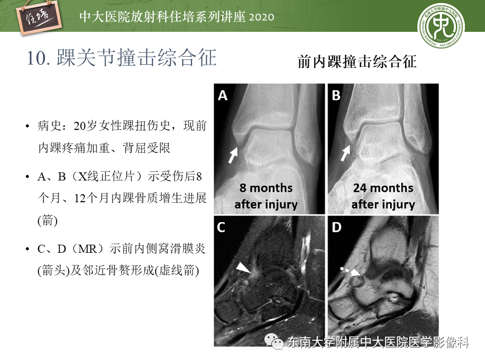 【PPT】常见撞击综合征的影像诊断-58