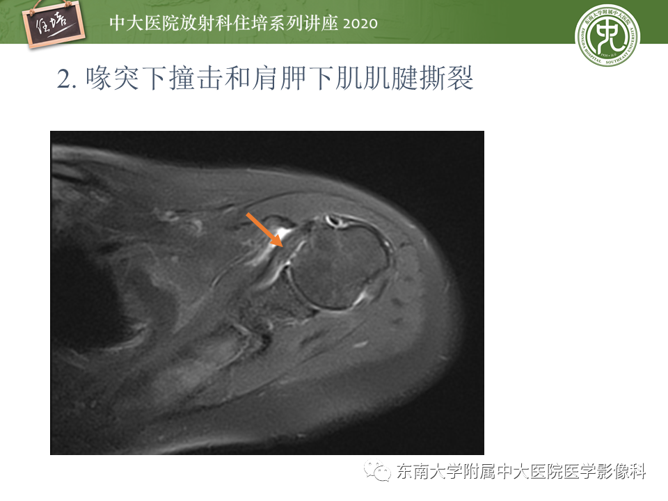 【PPT】常见撞击综合征的影像诊断-17
