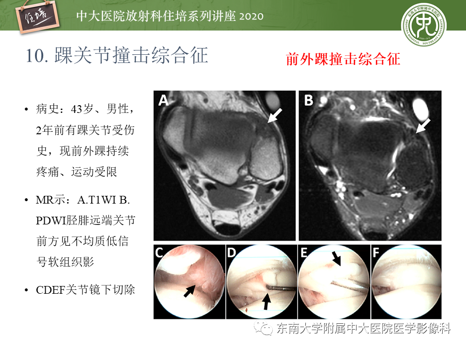 【PPT】常见撞击综合征的影像诊断-54