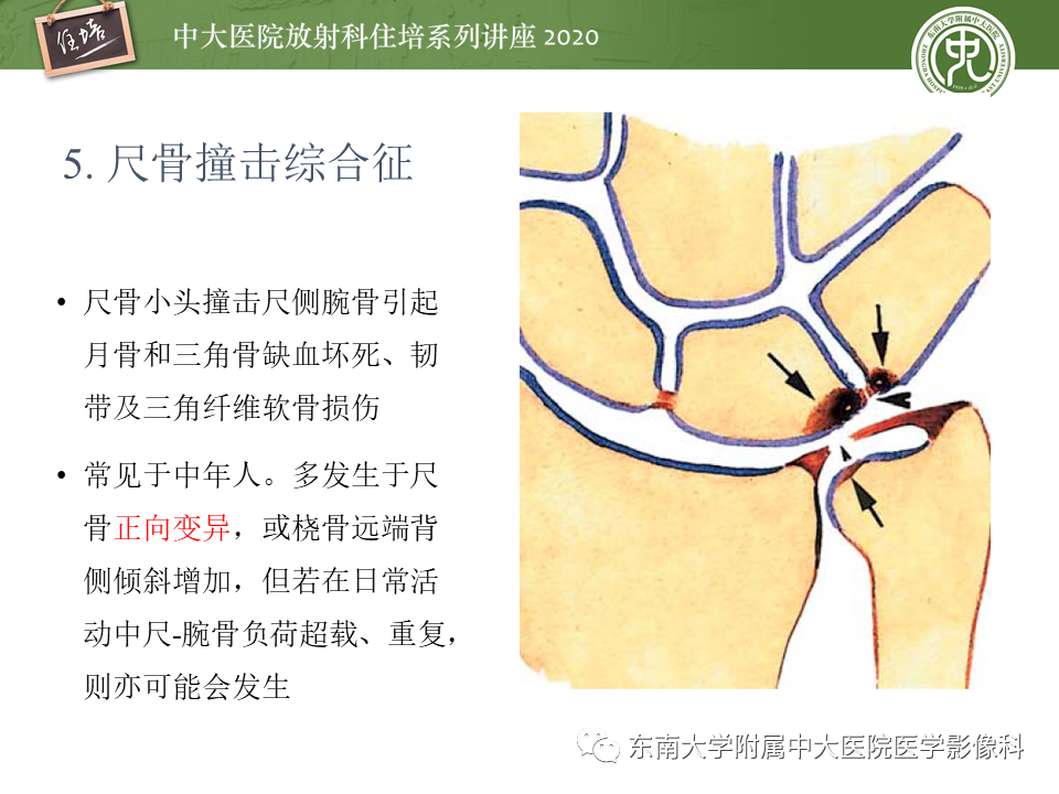 【PPT】常见撞击综合征的影像诊断-21