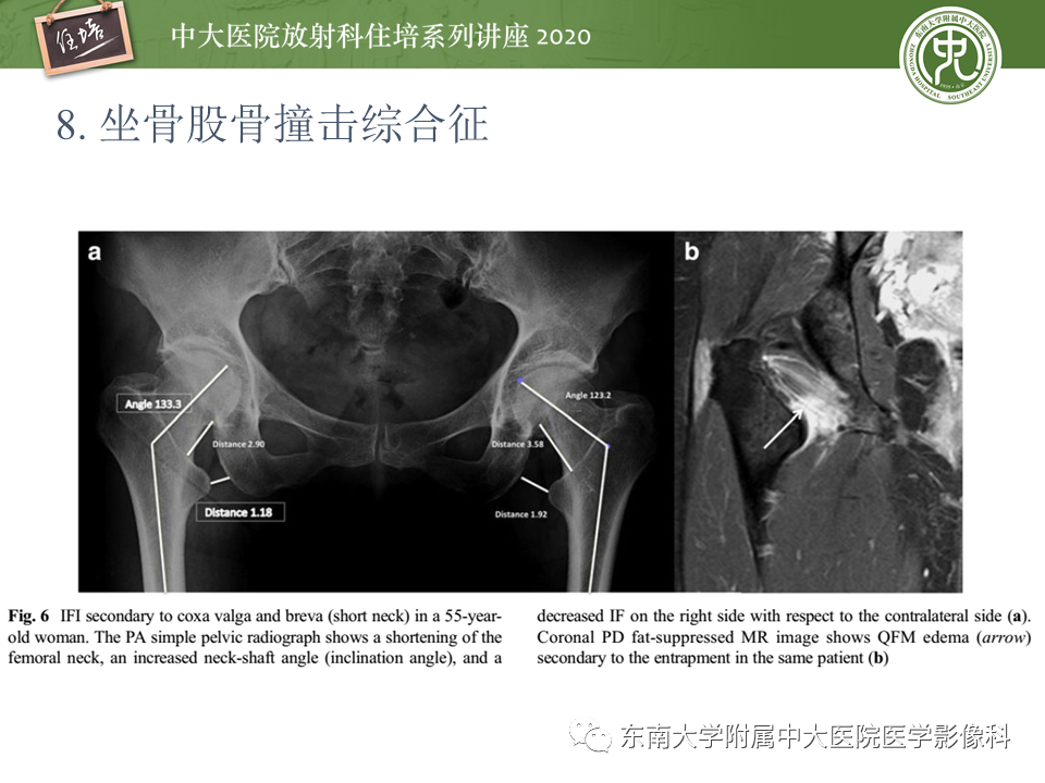 【PPT】常见撞击综合征的影像诊断-47
