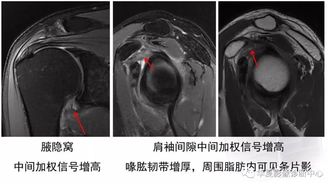 【PPT】四边孔综合征-12