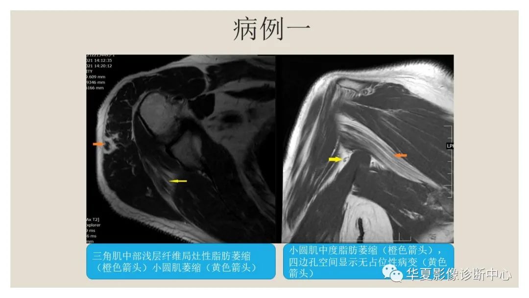 【PPT】四边孔综合征-8