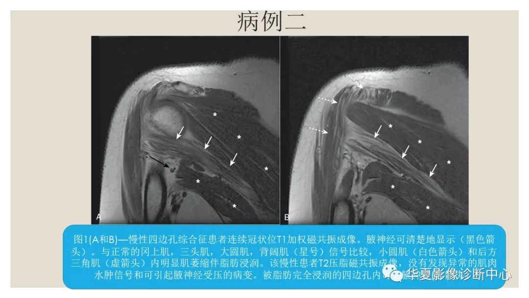 【PPT】四边孔综合征-9