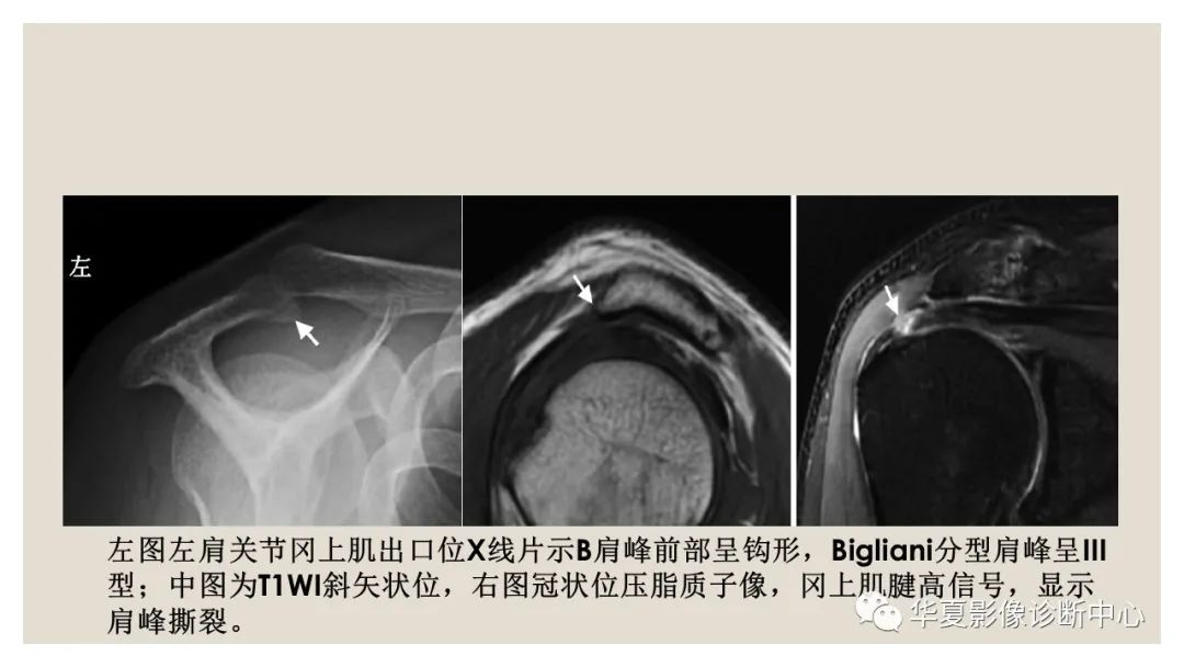 【PPT】四边孔综合征-14