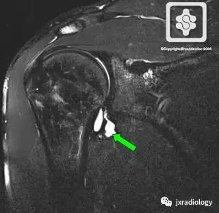 四边孔综合征-8
