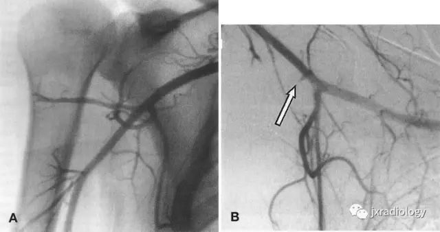四边孔综合征-10