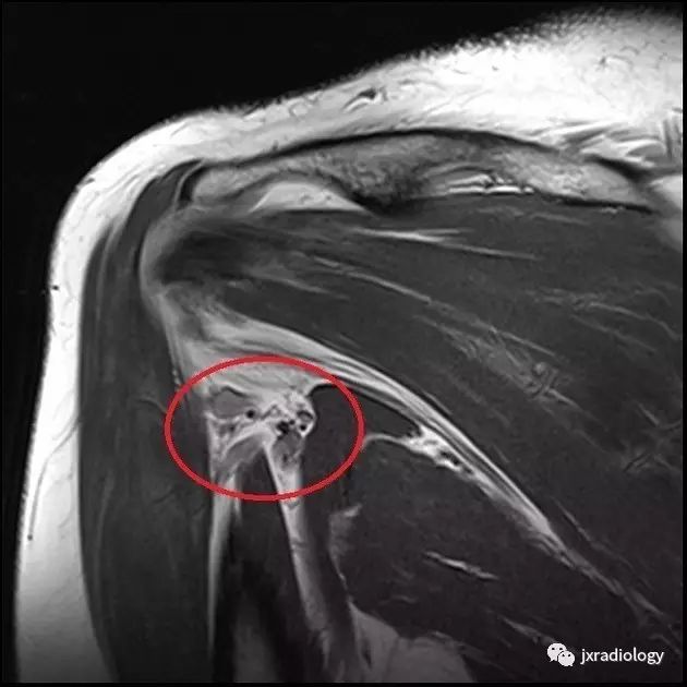 四边孔综合征-3