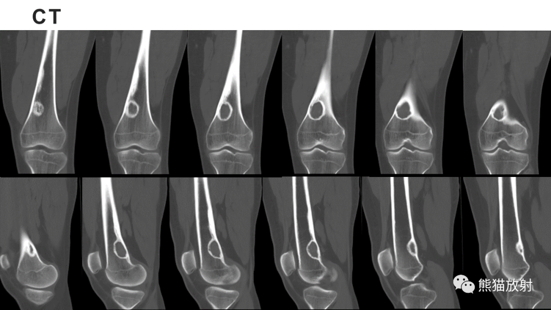 【病例】长骨非骨化性纤维瘤2例X线CT及MR-17