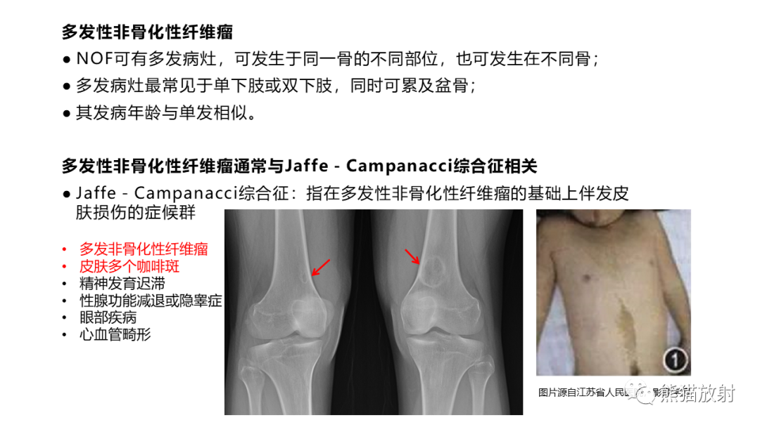 【病例】长骨非骨化性纤维瘤2例X线CT及MR-28