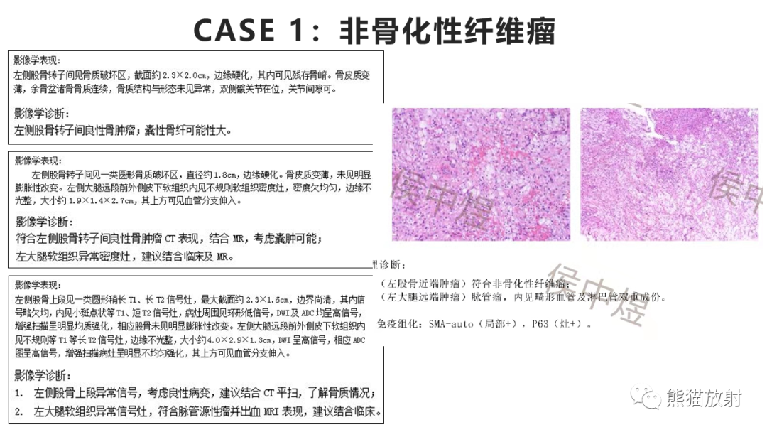 【病例】长骨非骨化性纤维瘤2例X线CT及MR-23