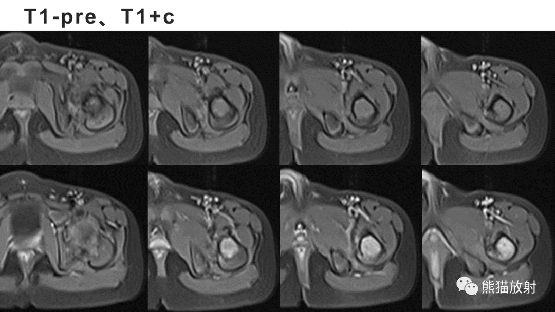 【病例】长骨非骨化性纤维瘤2例X线CT及MR-7