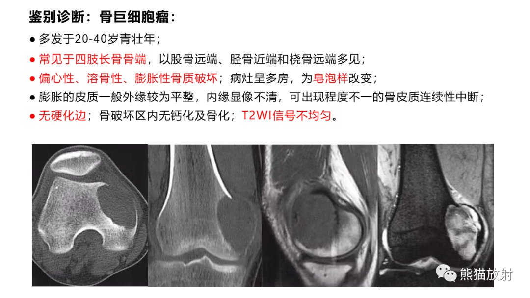 【病例】长骨非骨化性纤维瘤2例X线CT及MR-34